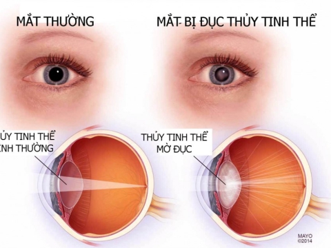 PHẪU THUẬT PHACO