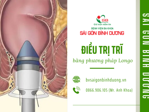 Điều trị trĩ bằng phương pháp Longo tại Bệnh viện Sài Gòn Bình Dương