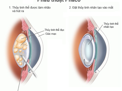 BỆNH ĐỤC THỦY TINH THỂ VÀ NHỮNG ĐIỀU CẦN BIẾT!