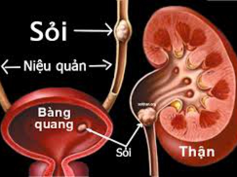 Phẫu thuât tán sỏi niệu bằng Laser 